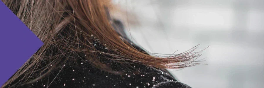 Does Gut Health Affect Dandruff?